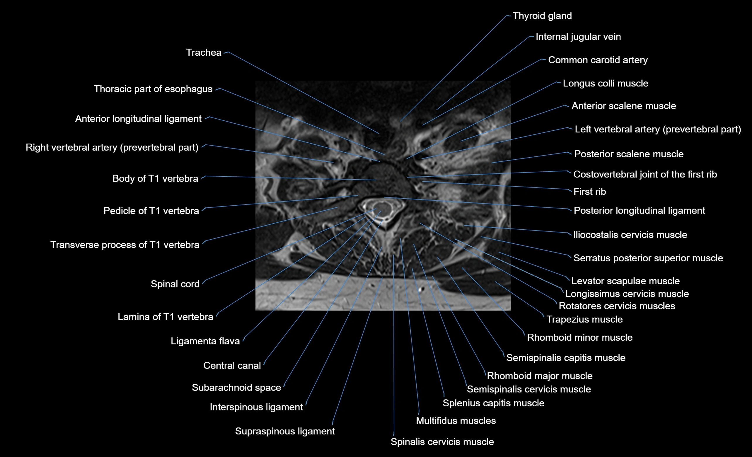 cervical spine cross sectional MRI anatomy  3T MRI axial  image-img-00001-00040.webp